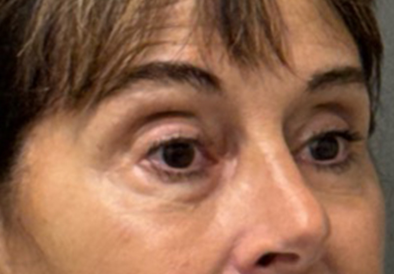 BLEPHAROPLASTY Before & After Gallery - Patient 122175 - Image 3