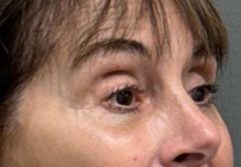 BLEPHAROPLASTY Before & After Gallery - Patient 122175 - Image 4