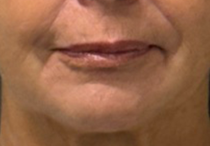 DERMAL FILLERS Before & After Gallery - Patient 359988 - Image 1