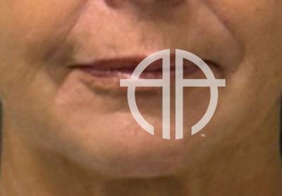 LIP FILLER Before & After Gallery - Patient 359988 - Image 1