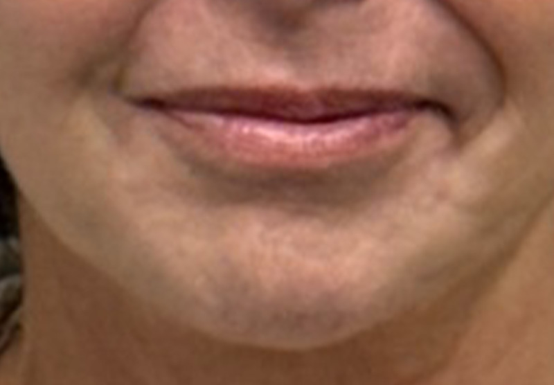 DERMAL FILLERS Before & After Gallery - Patient 359988 - Image 2