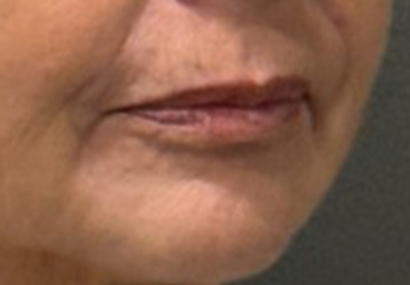 LIP FILLER Before & After Gallery - Patient 359988 - Image 3