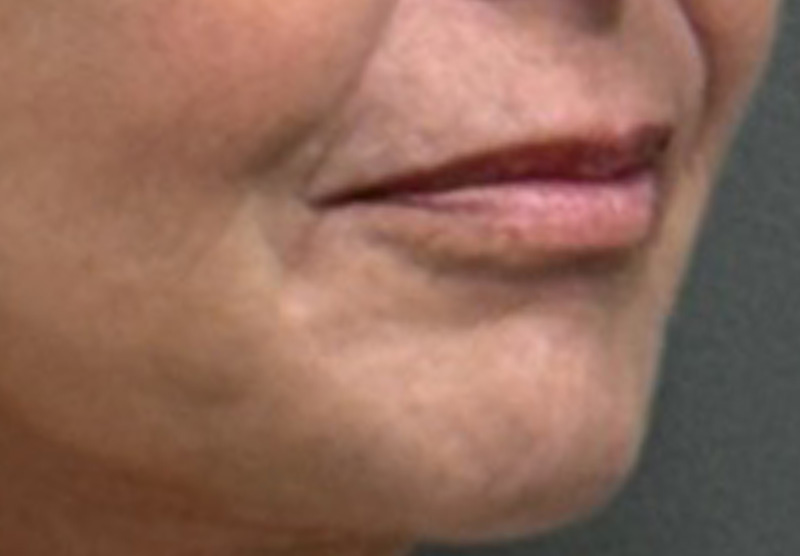 LIP FILLER Before & After Gallery - Patient 359988 - Image 4