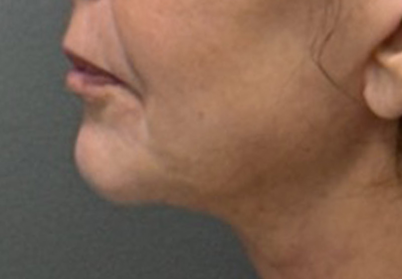 LIP FILLER Before & After Gallery - Patient 359988 - Image 6