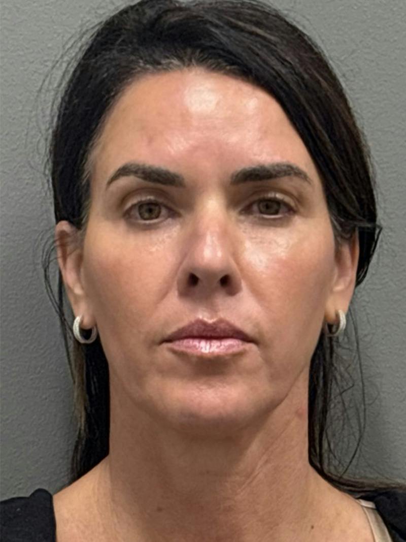 Facelift before and after