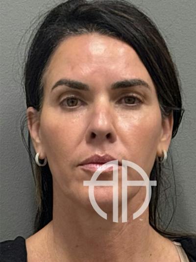 FACELIFT Before & After Gallery - Patient 145961 - Image 1