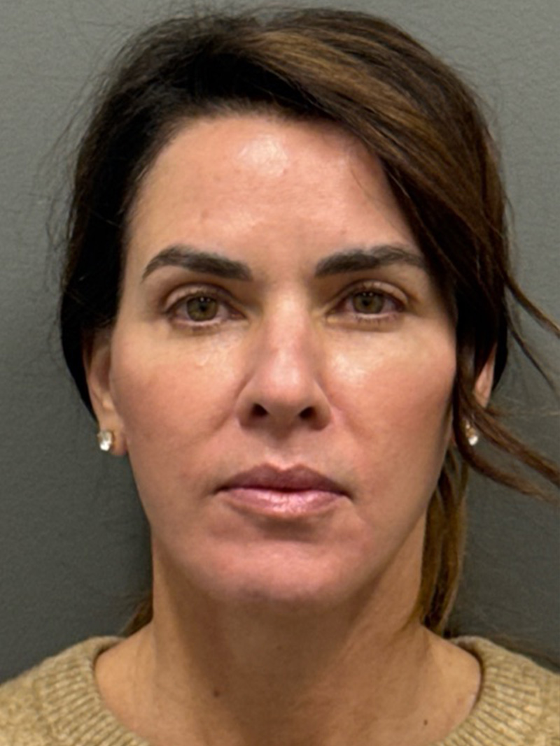 FAT GRAFTING Before & After Gallery - Patient 389516 - Image 2