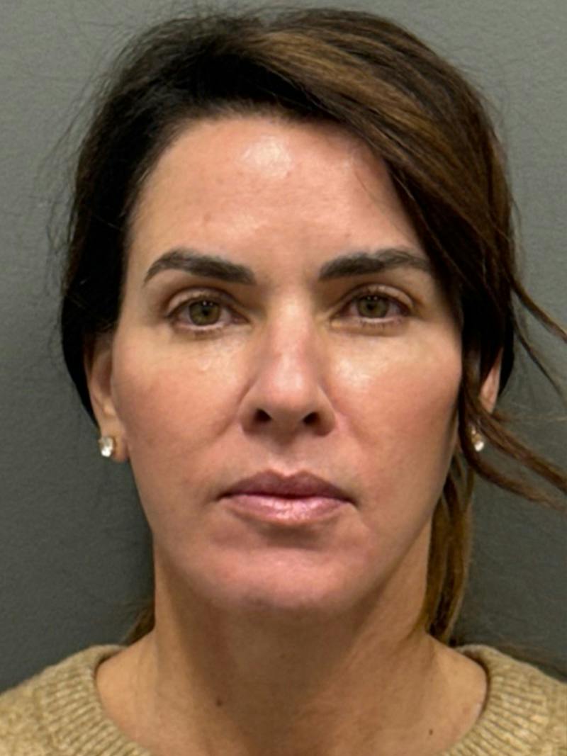 Facelift before and after
