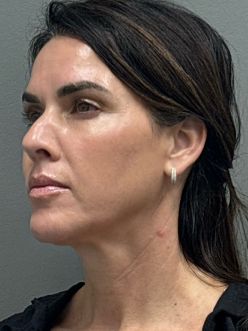 FAT GRAFTING Before & After Gallery - Patient 389516 - Image 3