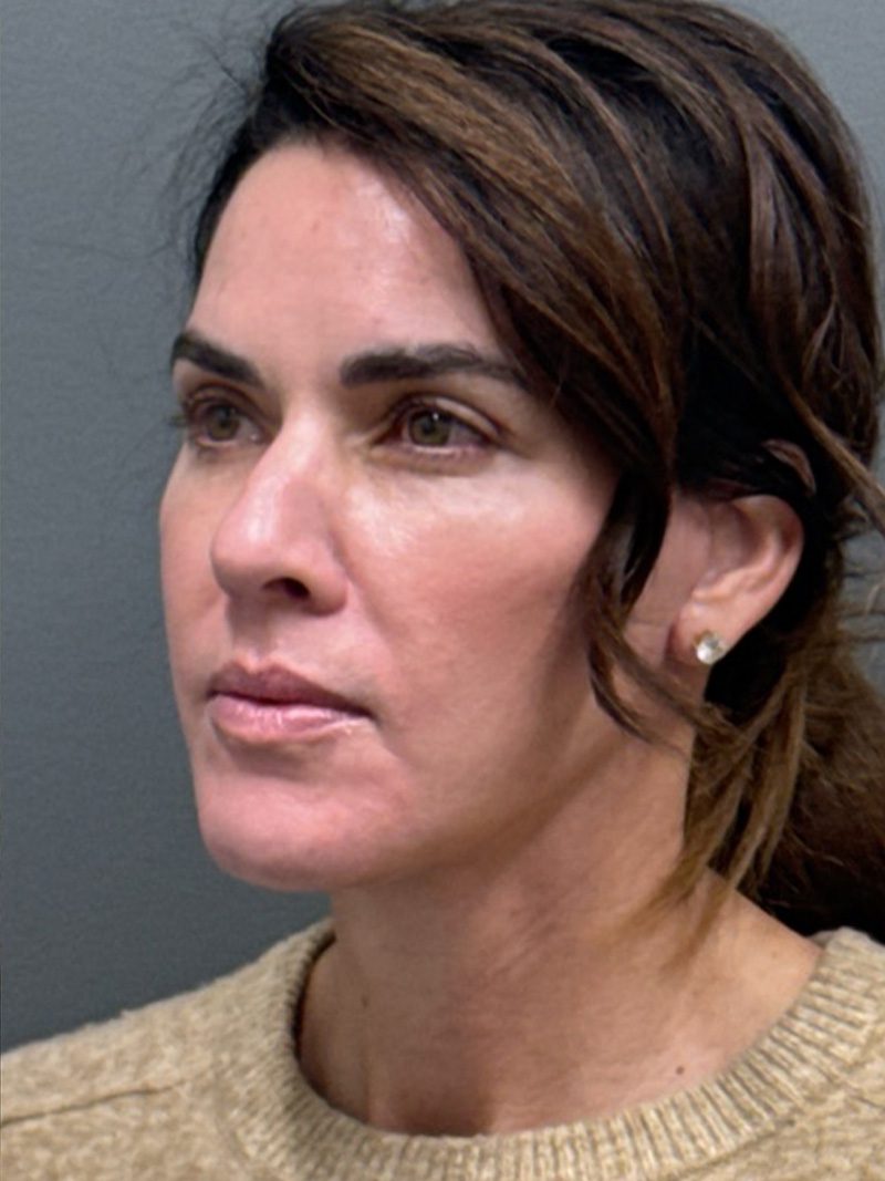 FAT GRAFTING Before & After Gallery - Patient 389516 - Image 4