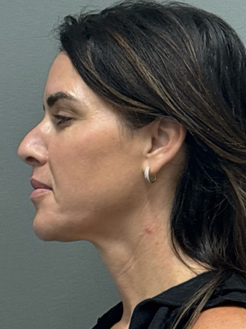 FAT GRAFTING Before & After Gallery - Patient 389516 - Image 5