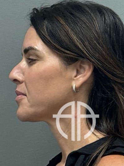 NECK LIFT Before & After Gallery - Patient 199656 - Image 1
