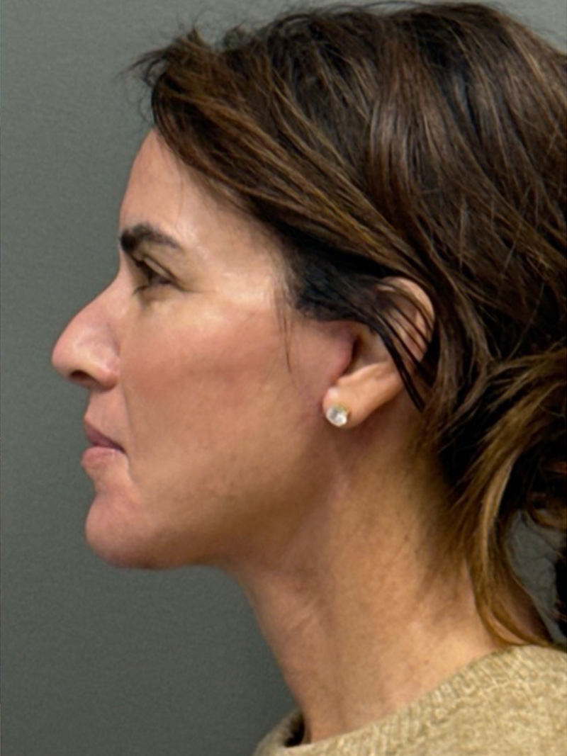 FAT GRAFTING Before & After Gallery - Patient 389516 - Image 6