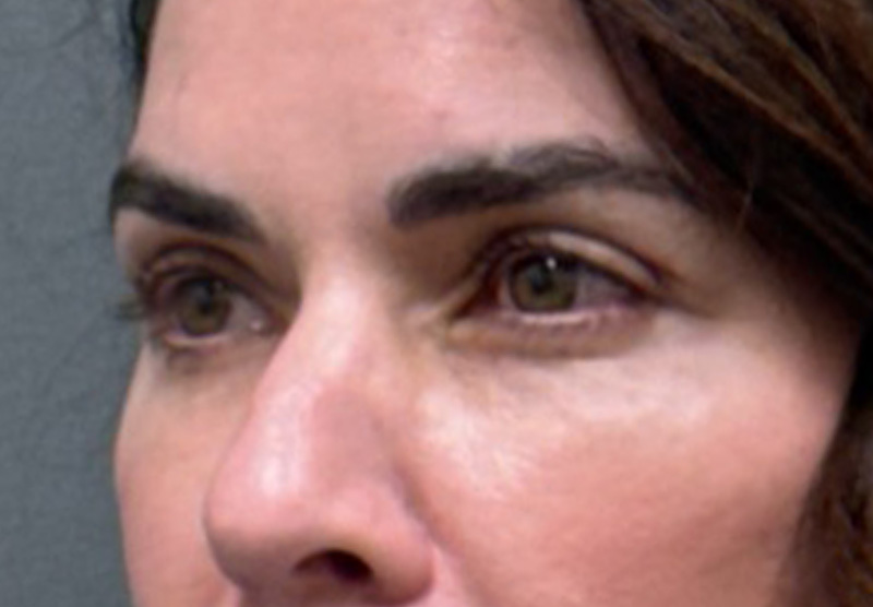 BLEPHAROPLASTY Before & After Gallery - Patient 900618 - Image 4