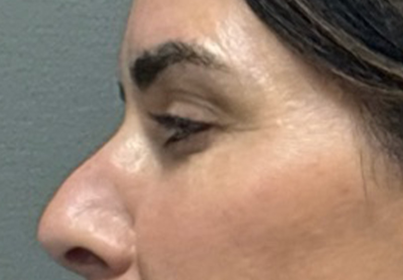 BLEPHAROPLASTY Before & After Gallery - Patient 900618 - Image 5