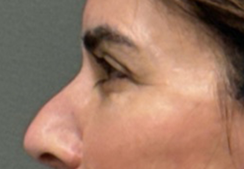 BLEPHAROPLASTY Before & After Gallery - Patient 900618 - Image 6