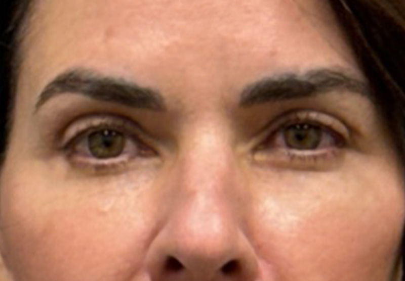 BLEPHAROPLASTY Before & After Gallery - Patient 900618 - Image 2