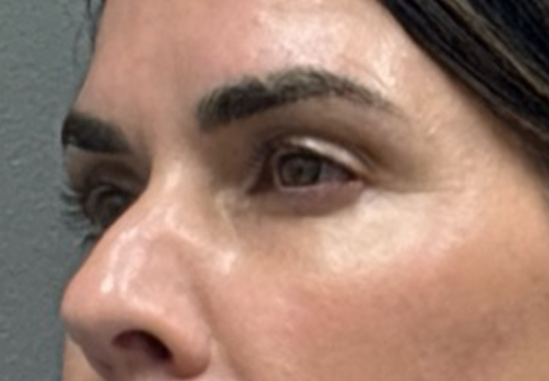 BLEPHAROPLASTY Before & After Gallery - Patient 900618 - Image 3