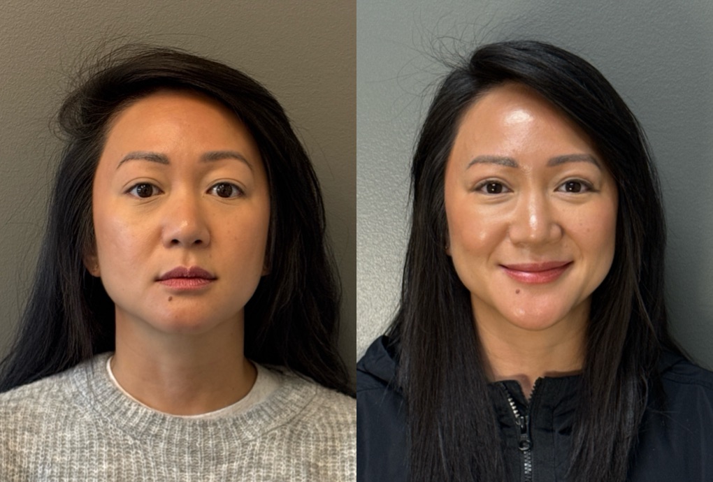 FACIAL BALANCING FILLER Before & After Gallery - Patient 264885 - Image 1