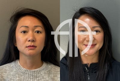 FACIAL BALANCING FILLER Before & After Gallery - Patient 264885 - Image 1