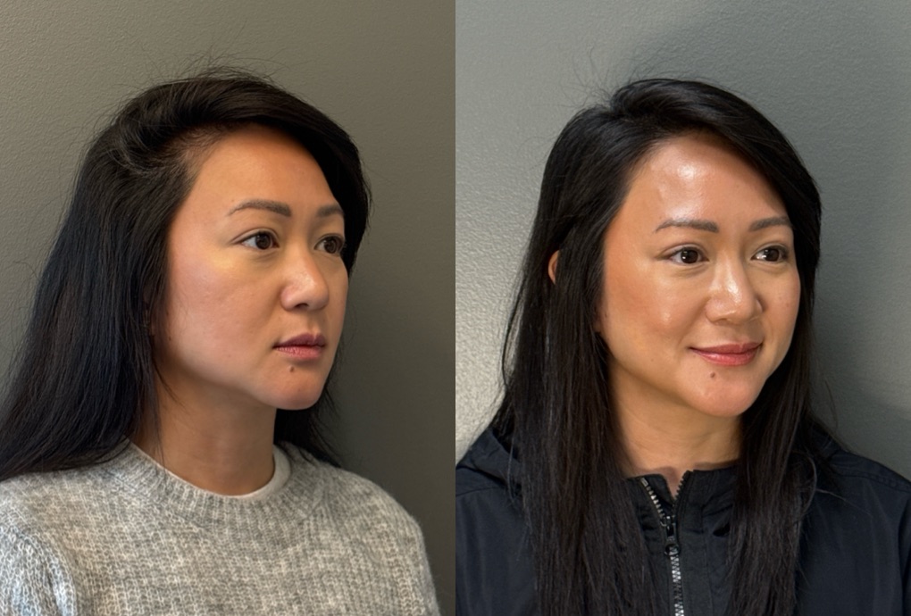 FACIAL BALANCING FILLER Before & After Gallery - Patient 264885 - Image 2