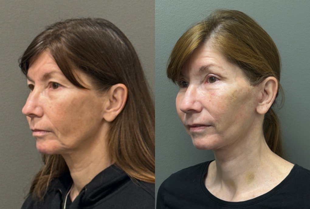 FAT GRAFTING Before & After Gallery - Patient 293288 - Image 3