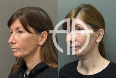 NECK LIFT Before & After Gallery - Patient 359744 - Image 1