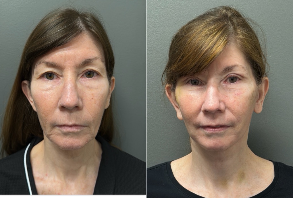 FAT GRAFTING Before & After Gallery - Patient 293288 - Image 1