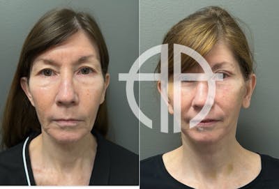 FACELIFT Before & After Gallery - Patient 158942 - Image 1