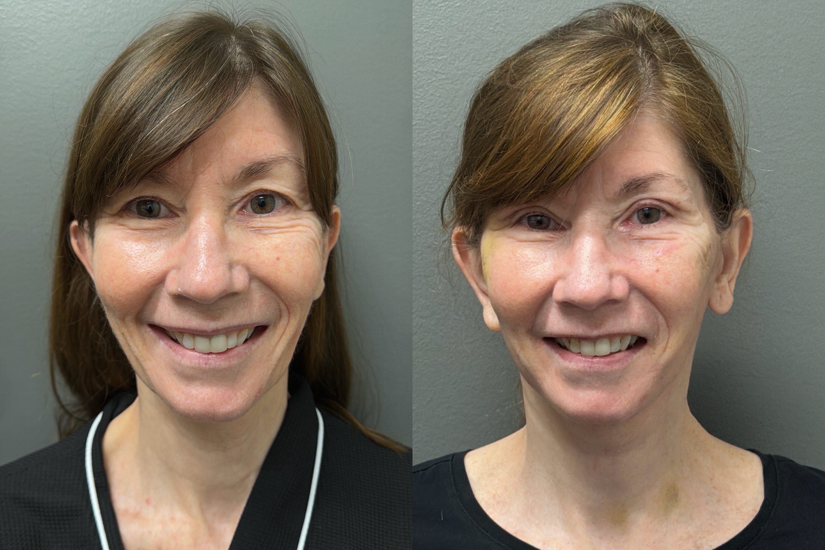 FAT GRAFTING Before & After Gallery - Patient 293288 - Image 2