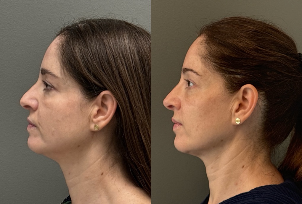 FACIAL BALANCING FILLER Before & After Gallery - Patient 185762 - Image 3