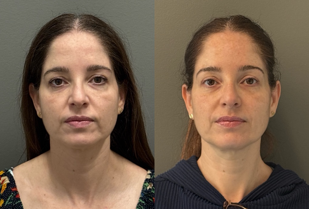 FACIAL BALANCING FILLER Before & After Gallery - Patient 185762 - Image 1