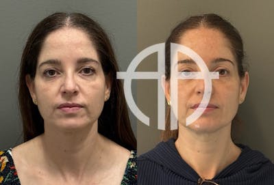 FACIAL BALANCING FILLER Before & After Gallery - Patient 185762 - Image 1