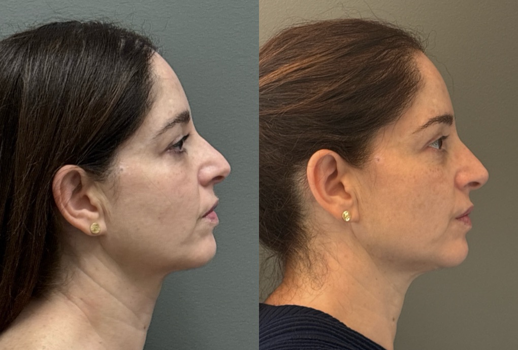 FACIAL BALANCING FILLER Before & After Gallery - Patient 185762 - Image 4