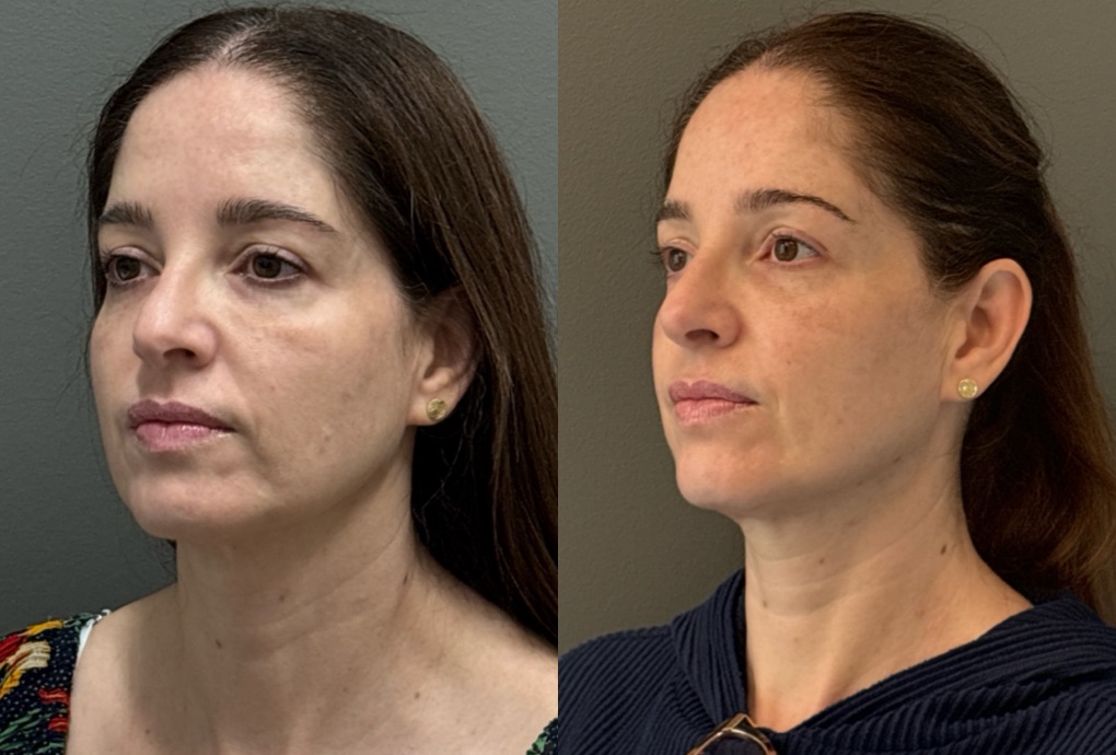 FACIAL BALANCING FILLER Before & After Gallery - Patient 185762 - Image 2