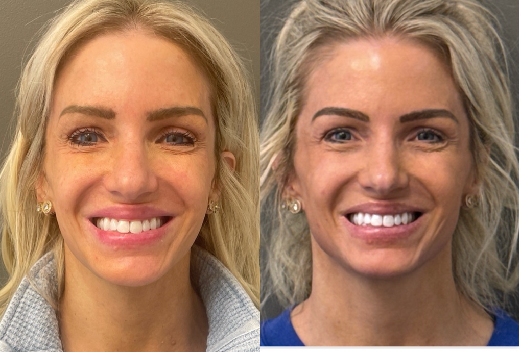 FACIAL BALANCING FILLER Before & After Gallery - Patient 142500 - Image 3