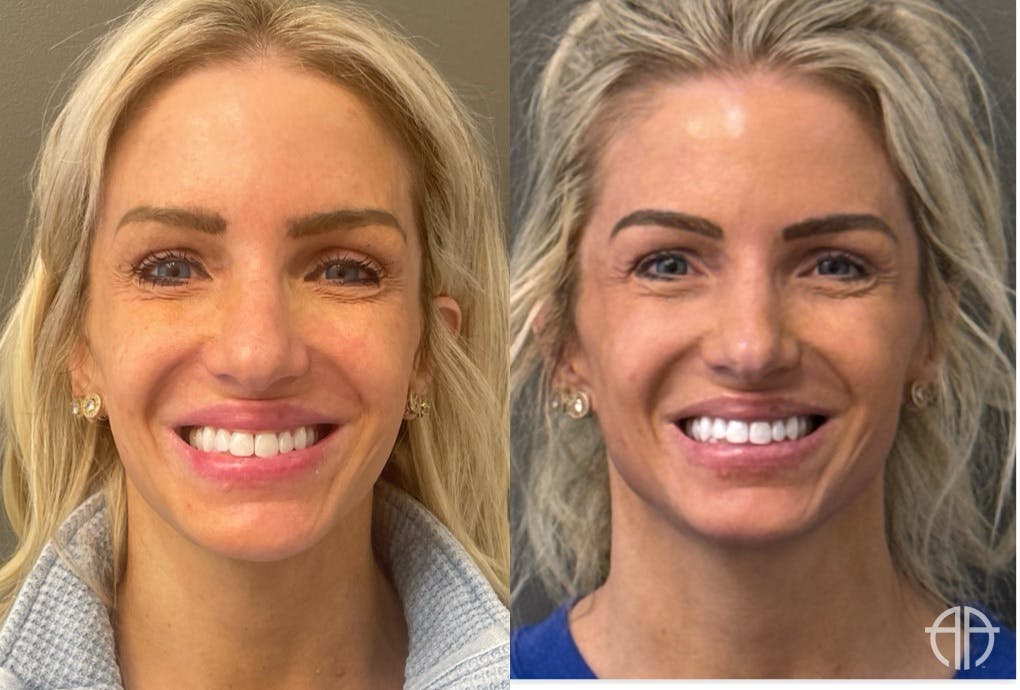 FACIAL BALANCING FILLER Before & After Gallery - Patient 142500 - Image 3
