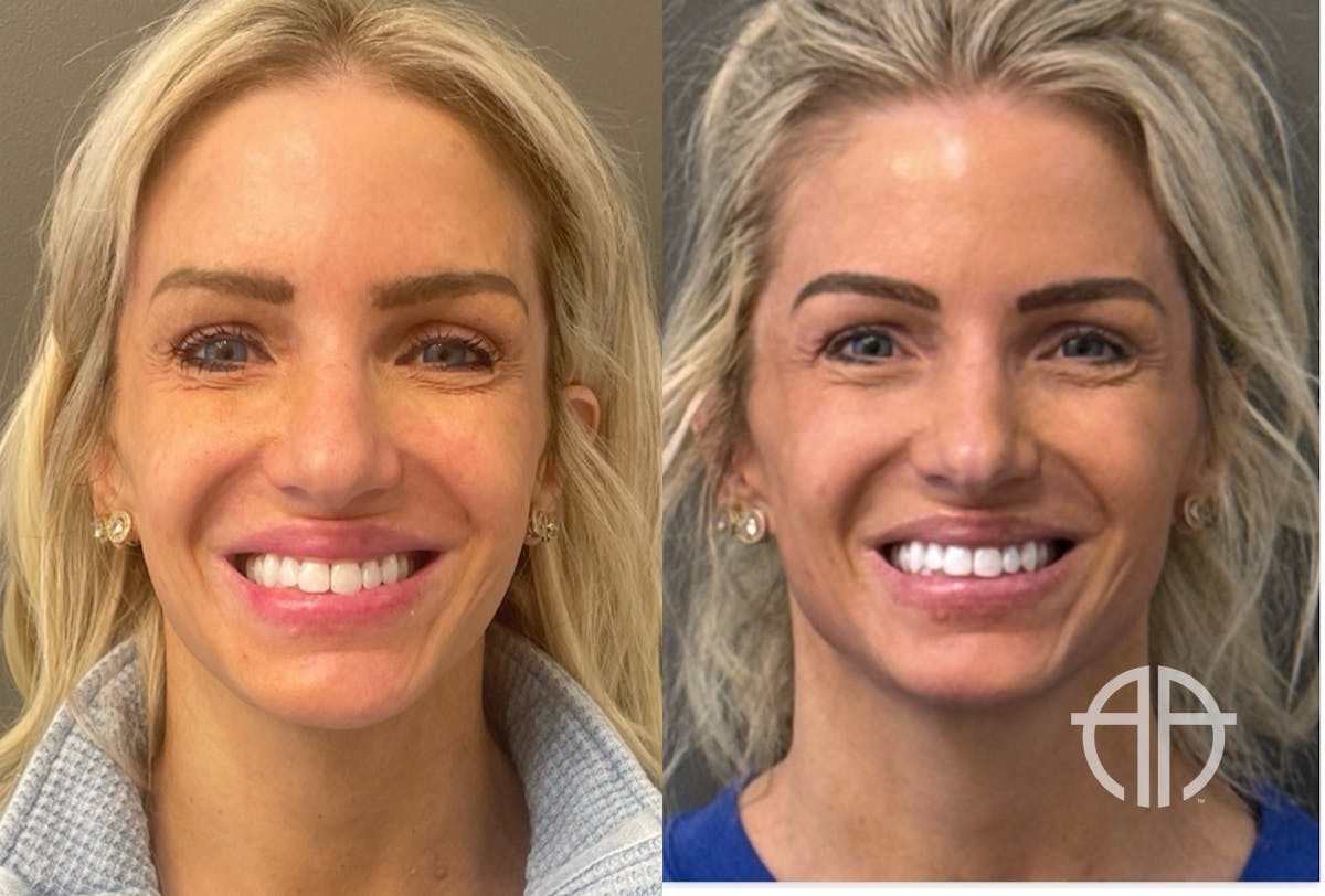FACIAL BALANCING FILLER Before & After Gallery - Patient 142500 - Image 3