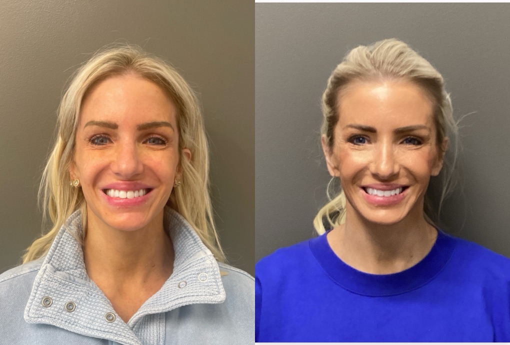 FACIAL BALANCING FILLER Before & After Gallery - Patient 142500 - Image 1