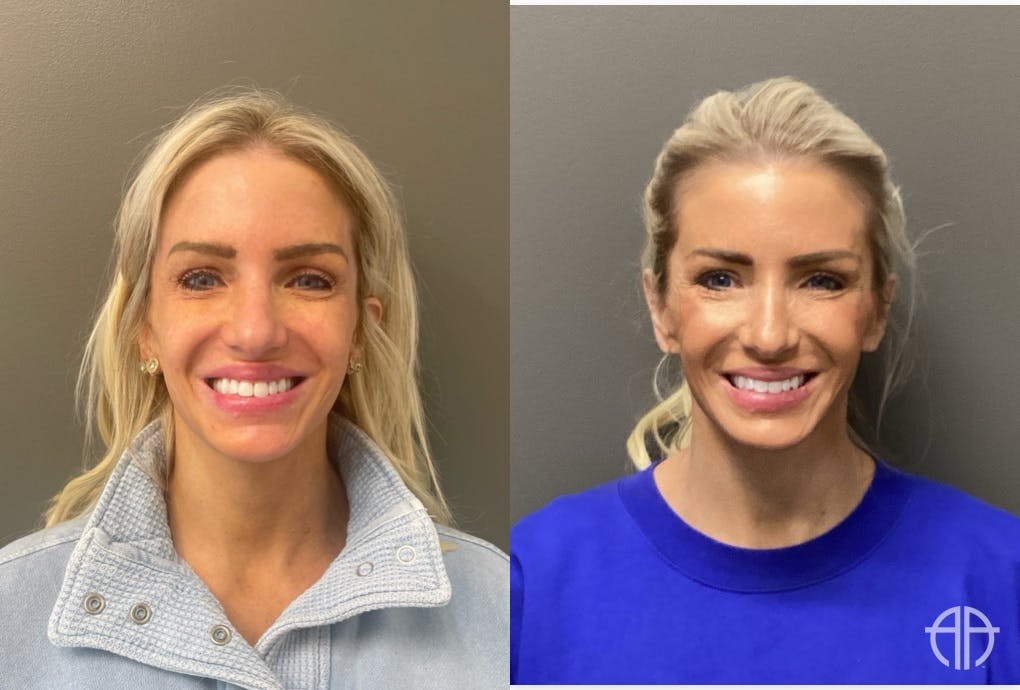 FACIAL BALANCING FILLER Before & After Gallery - Patient 142500 - Image 1