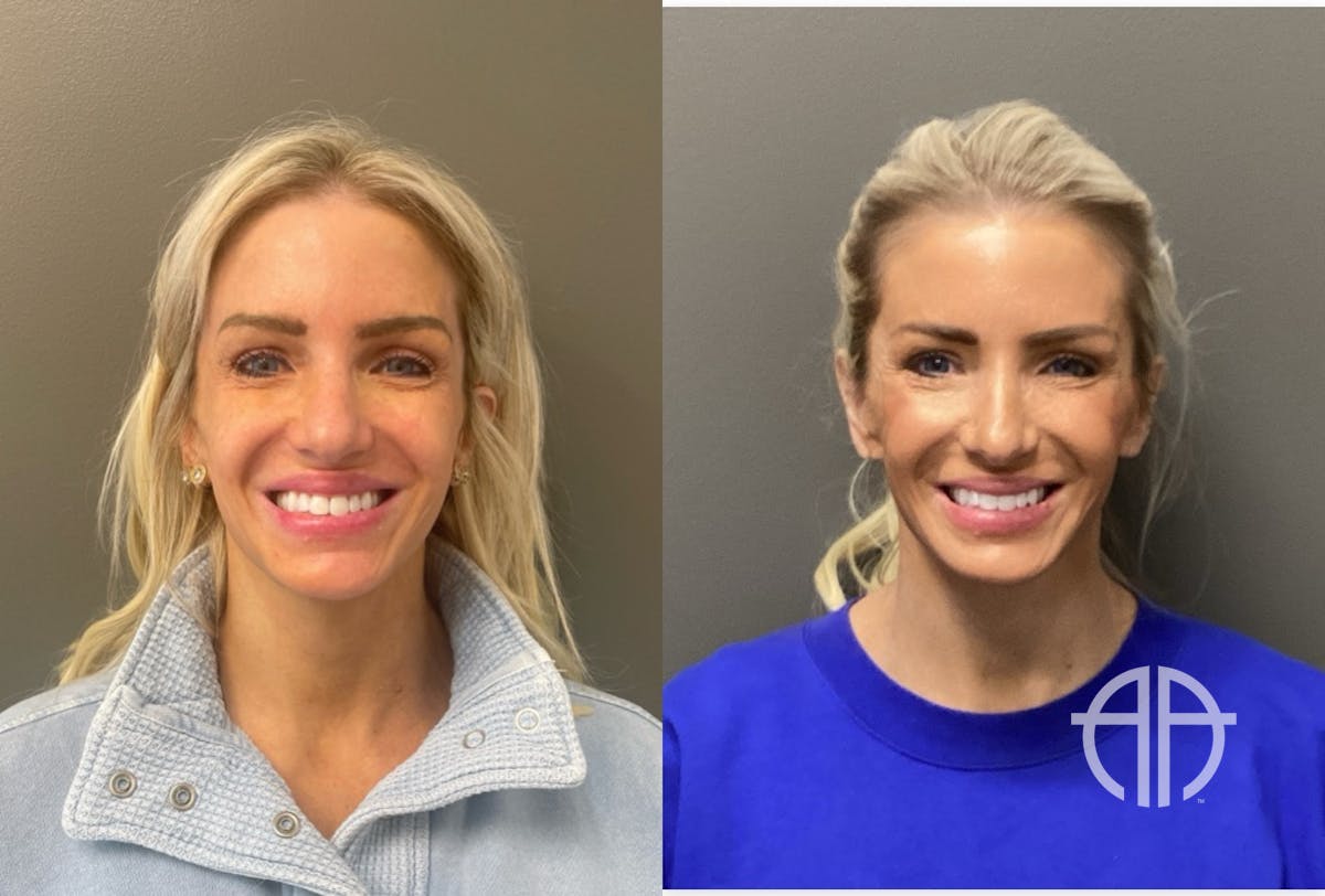 FACIAL BALANCING FILLER Before & After Gallery - Patient 142500 - Image 1
