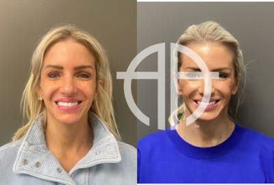 FACIAL BALANCING FILLER Before & After Gallery - Patient 142500 - Image 1