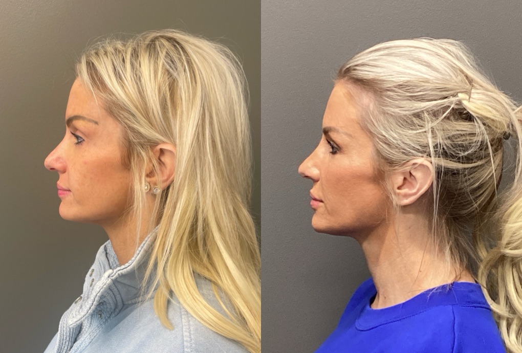 FACIAL BALANCING FILLER Before & After Gallery - Patient 142500 - Image 2