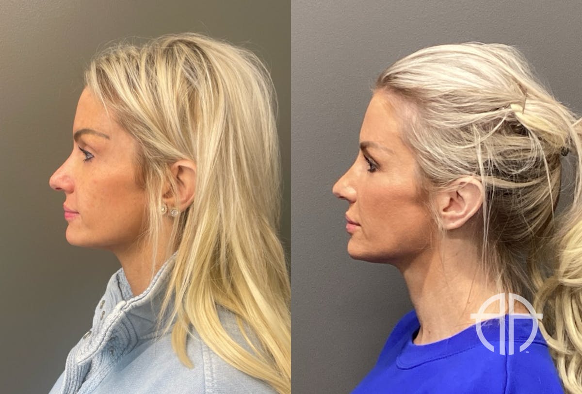 FACIAL BALANCING FILLER Before & After Gallery - Patient 142500 - Image 2