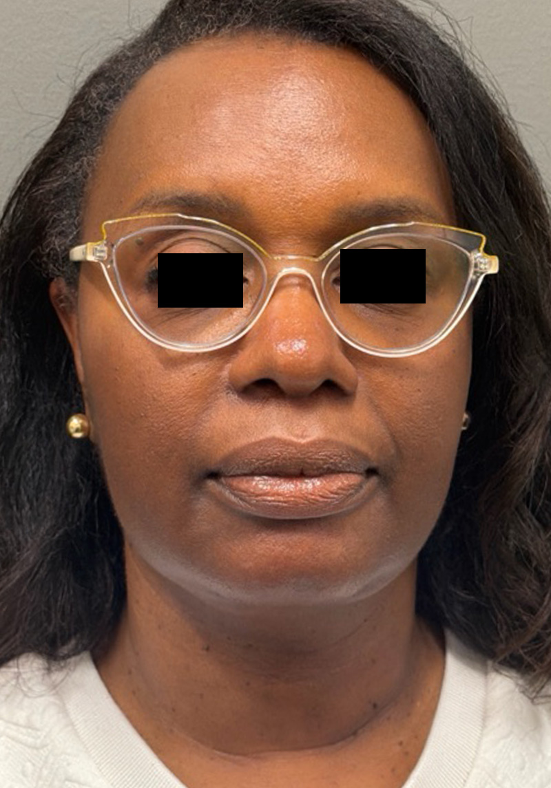 NECK LIFT Before & After Gallery - Patient 419306 - Image 6