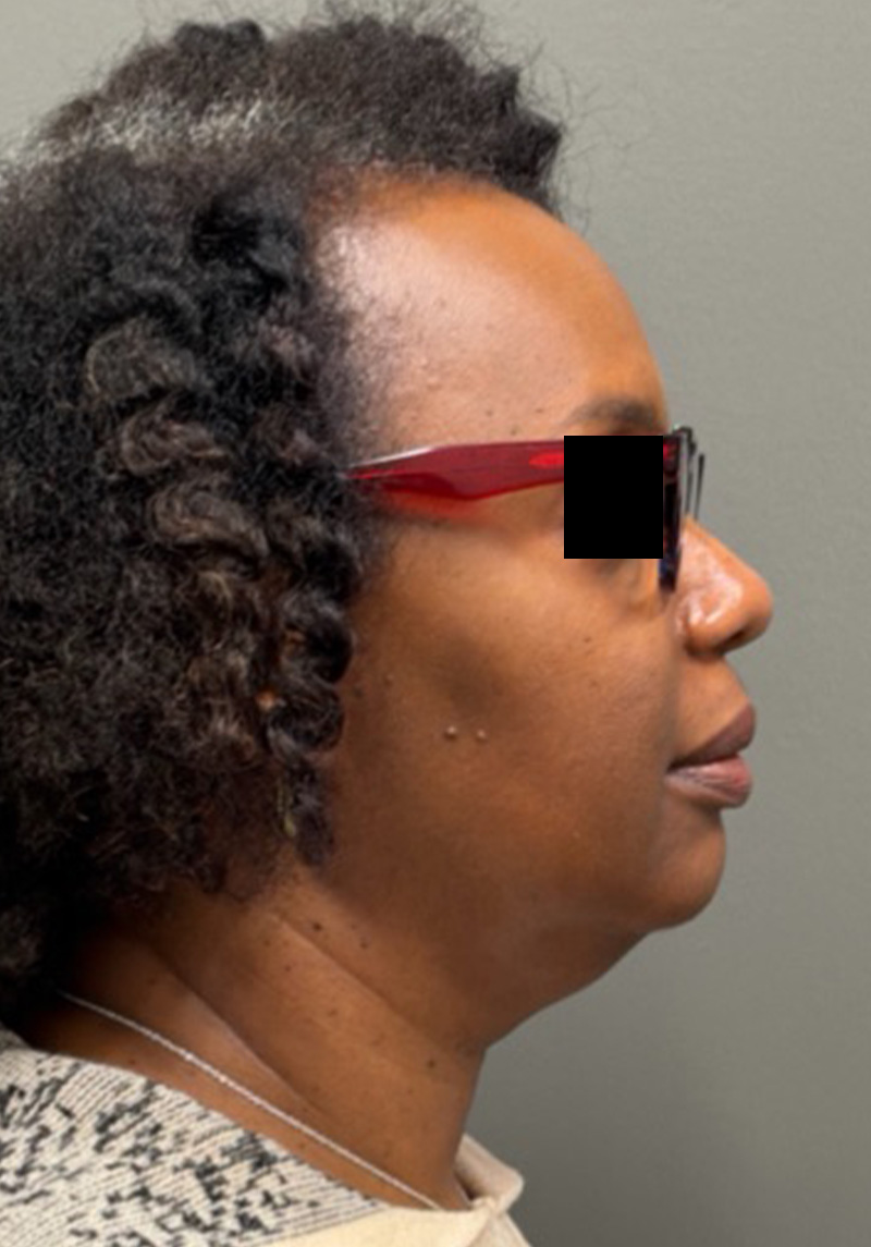 NECK LIFT Before & After Gallery - Patient 419306 - Image 1