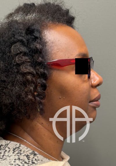 NECK LIFT Before & After Gallery - Patient 419306 - Image 1