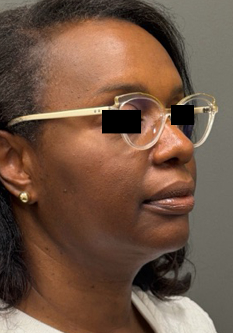 NECK LIFT Before & After Gallery - Patient 419306 - Image 4