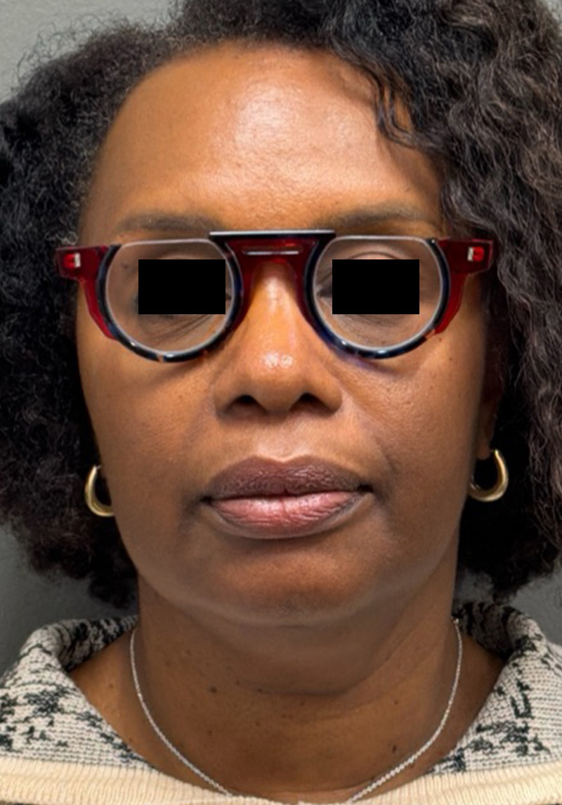 NECK LIFT Before & After Gallery - Patient 419306 - Image 5