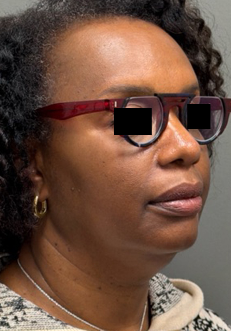 NECK LIFT Before & After Gallery - Patient 419306 - Image 3